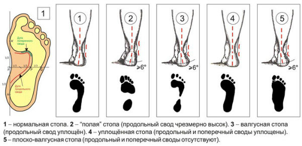 Схема плоскостопия